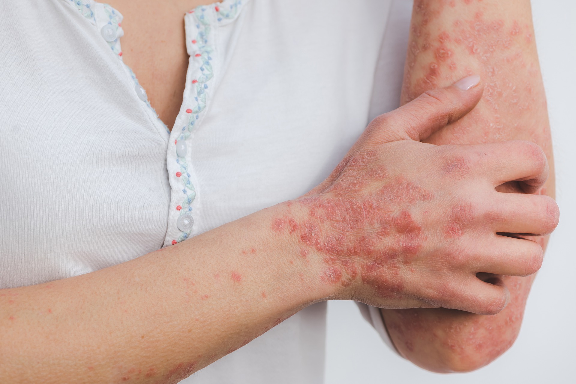 Quelles sont les solutions naturelles pour soigner le psoriasis ?